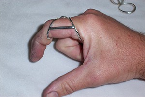 alat bantu jari tangan kaku triiger finger di Flex Free Musculoskeletal Rehabilitation Clinic
