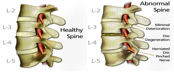 Terapi Dekompresi Spinal; Pengobatan Sakit Punggung Bawah (Low Back