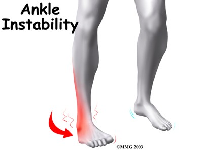 ankle instability