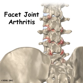 Kerusakan Sendi Facet pada Osteoarthritis