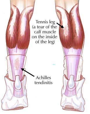 betis sakit karena cedera olah raga tennis leg