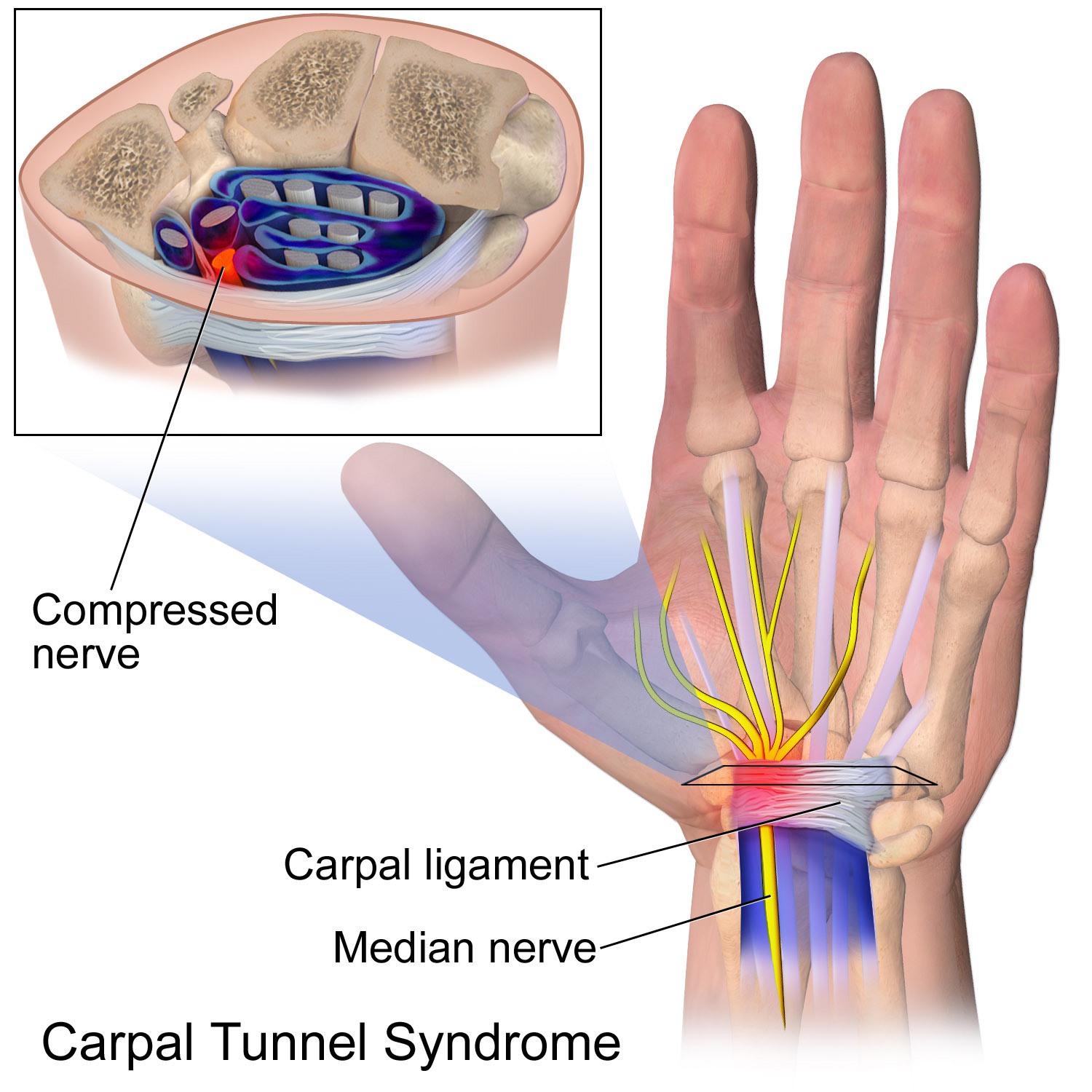 Pregnancy and Carpal Tunnel Syndrome - Giggle Magazine