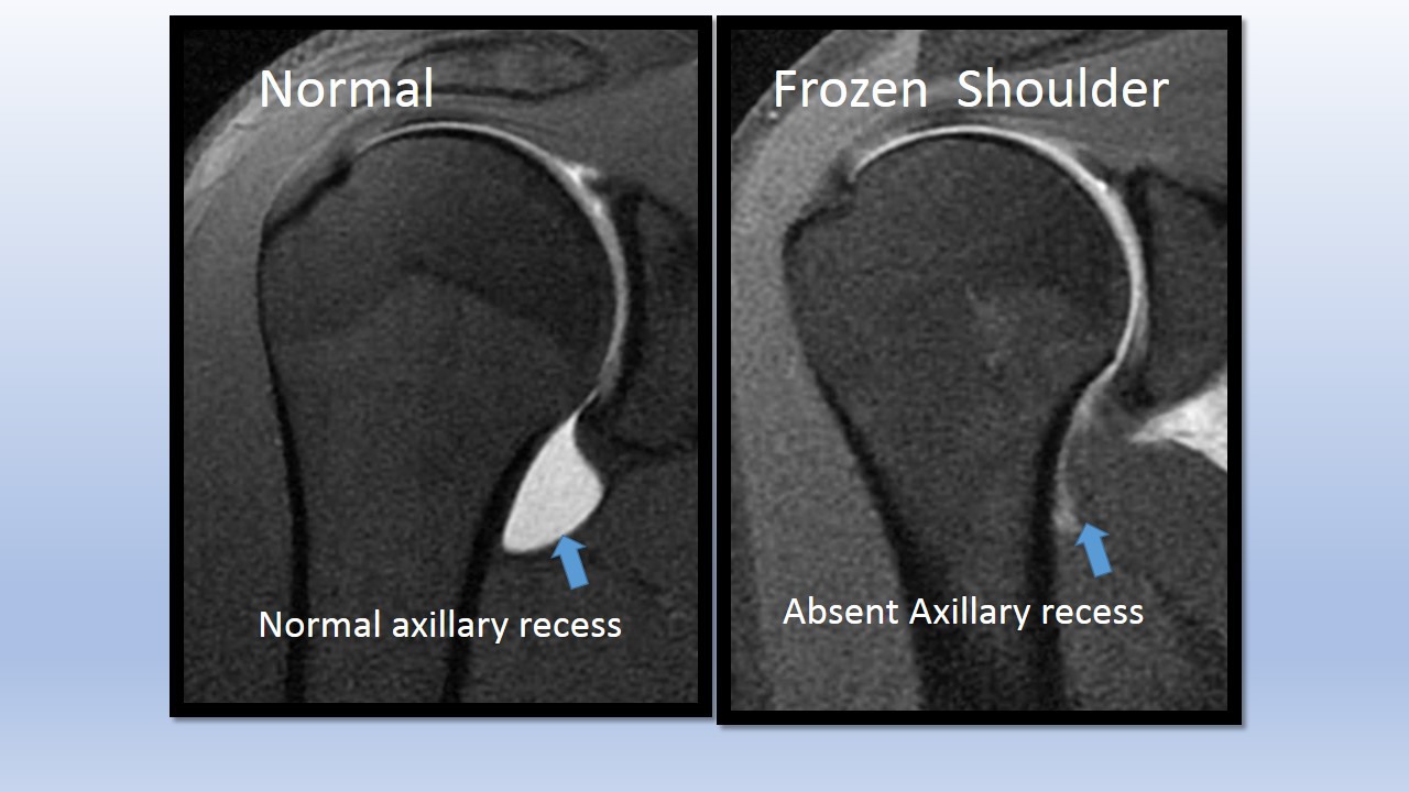 Gambaran MRI pada frozen shoulder