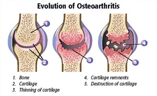 Evolusi kerusakan jaringan pada OA lutut