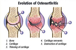perubahan lutut sakit karena osteoartheritis