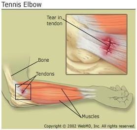 faktor resiko tennis elbow