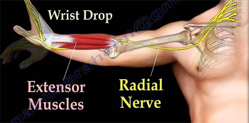 gejala Radial Tunnel Syndrome wrist drop