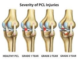 cedera ligamen lutut belakang (PCL)