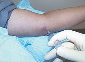 injeksi steroid sebagai obat tennis elbow