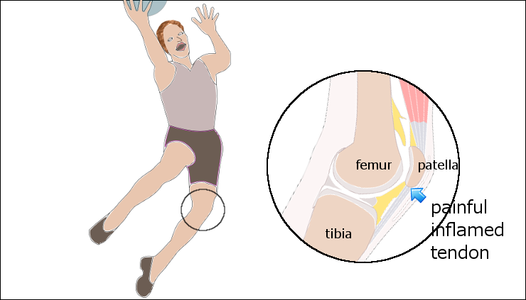 lokasi peradangan di bagian bawah lutut pada jumpers knee