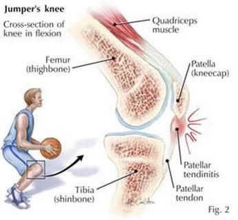 lokasi peradangan jumpers knee