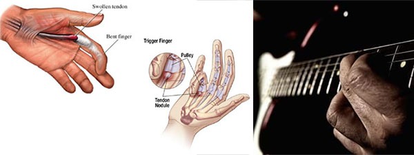 kelainan Trigger Finger