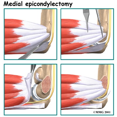 Langkah-langkah pembedahan pada tehnik Medial Epicondylectomy
