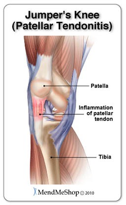Nyeri lutut saat loncat Patellar Tendonitis
