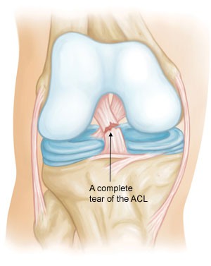 Cedera ligamen lutut