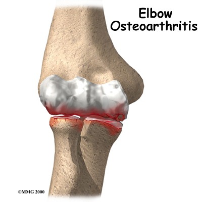 ostearthritis elbow