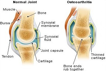 akut osteoarthritis tabletták arthrosis és ízületi gyulladás ellen