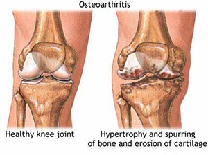 osteoarthritis penyebab lutut sakit