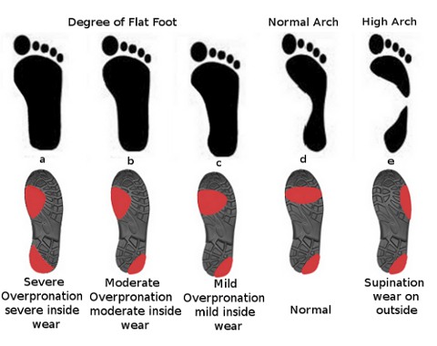 Dampak flat feet pada keausan sepatu