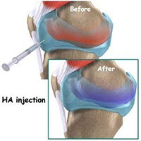 pengobatan lutut sakit dengan injeksi hyaluronat