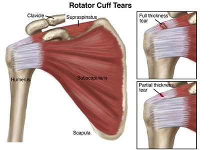 penyebab rotator cuff tear