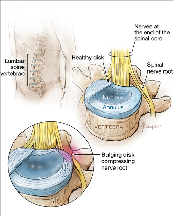 Jepitan saraf di vertebra lumbal penyebab nyeri punggung