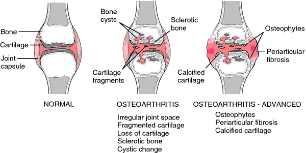 Boka akut osteoarthritis kezelése