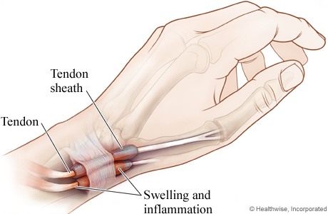 Pergelangan tangan sakit de quervain's tenosynivitis - flex free clinic