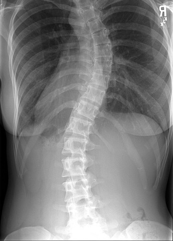 hasil x-ray scoliosis