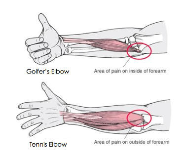 Tendinitis elbow golfers elbow and tennis elbow