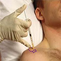 terapi injekst untuk pengobatan rotator cuff tear