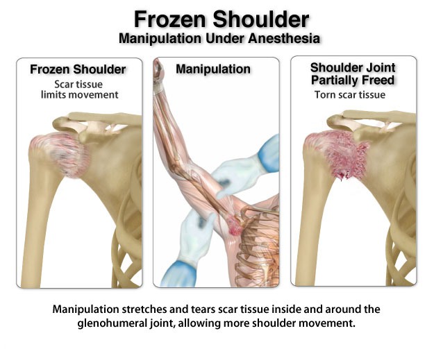 terapi frozen shoulder dengan manipulasi bahu