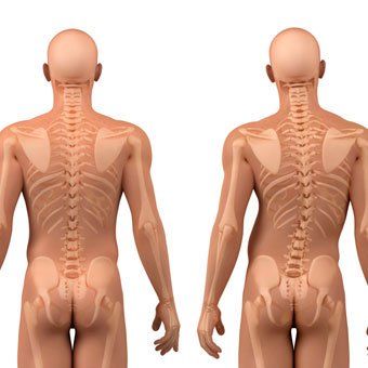 Kondisi dimana tulang belakang bagian punggung membengkok ke kiri atau ke kanan disebut kelainan tulang disebut