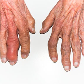 rheumatoid arthritis ízületi röntgenképe