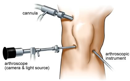 operasi arthroscopy lutut