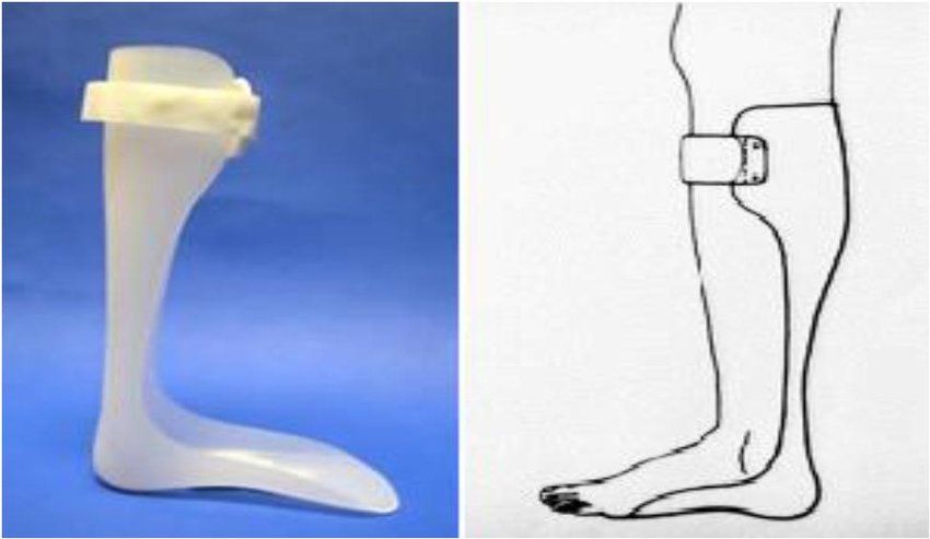 Contoh Alat Bantu Jalan Ankle Foot Orthosis