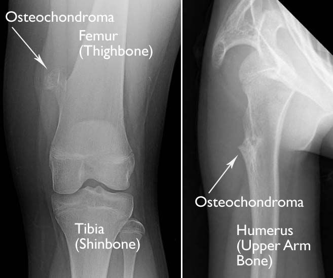 Gambaran Osteokondroma penyakit tulang langka