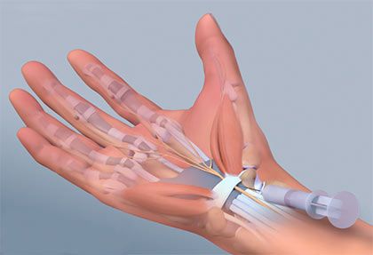 Injeksi terapi pada tangan kesemutan