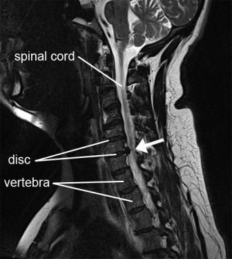 MRI saraf kejepit leher