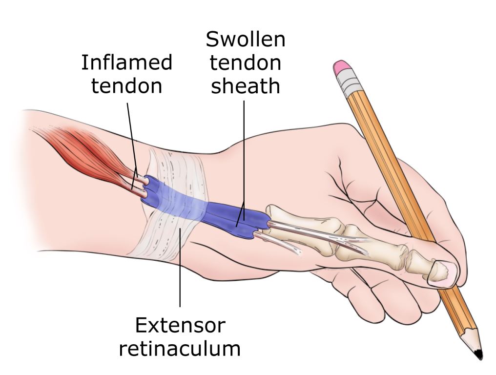 Nyeri Pergelangan Tangan karena De Quervain Tenosynovitis