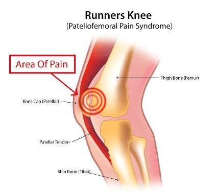 Penyebab lutut sakit saat ditekuk dan diluruskan pada Runners Knee
