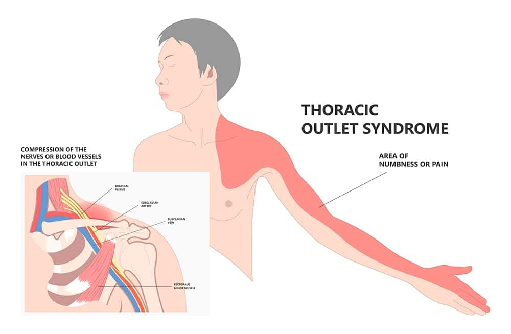 Penyebab nyeri lengan atas akibat Thoracic Outlet Syndrome