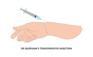 Rehabilitasi Nyeri Pergelangan Tangan akibat De Quervain Tenosynovitis