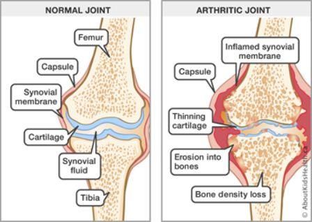 arthritis juvenile