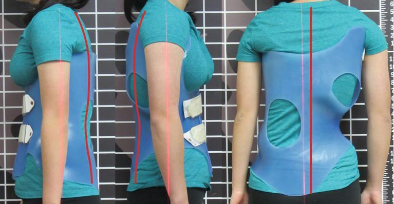 brace skoliosis pada anak