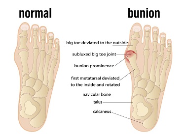 dampak memakai sepatu sempit