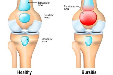 bursitis prepatellar
