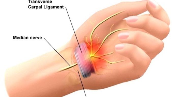 carpal tunnel syndrome penyebab tangan kesemutan