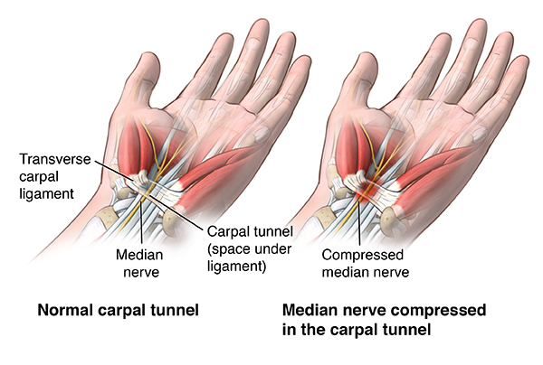 carpal tunnel syndrome penyebab kesemutan pada tangan