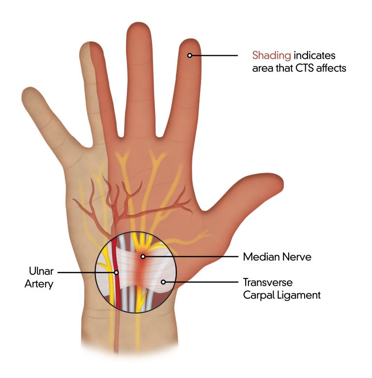 carpal tunnel syndrome penyebab nyeri pergelangan tangan 